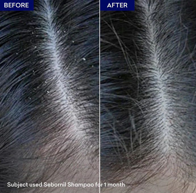 Sebornil Shampoo - Image 5